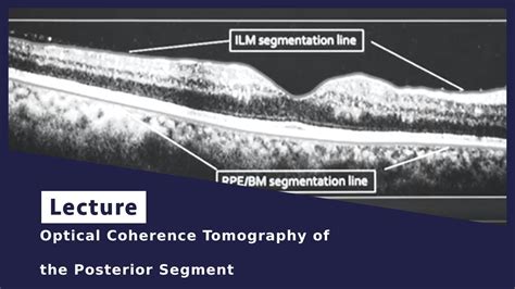 optical coherence tomography procedure